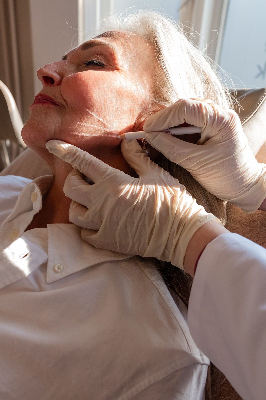 Sculptra Treatment